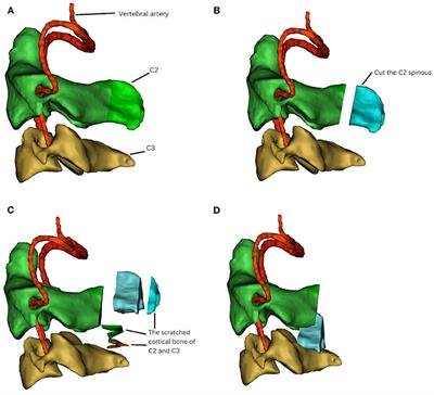 Comparison of C2-3 Pedicle Screw Fixation With C2 Spinous Muscle Complex and Iliac Bone Graft for Instable Hangman Fracture